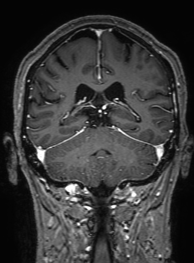 Cavernous hemangioma of the cerebellar falx (Radiopaedia 73025-83724 Coronal T1 C+ 248).jpg