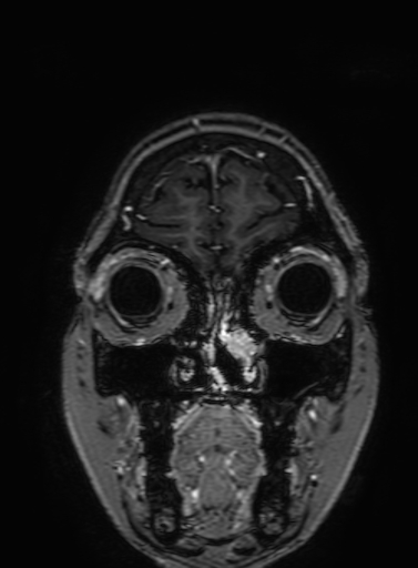 Cavernous hemangioma of the cerebellar falx (Radiopaedia 73025-83724 Coronal T1 C+ 49).jpg