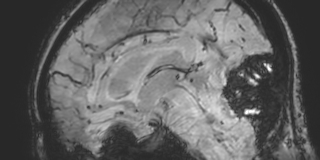 Cavernous hemangioma of the cerebellar falx (Radiopaedia 73025-83724 Sagittal BOLD 101).jpg