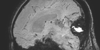 Cavernous hemangioma of the cerebellar falx (Radiopaedia 73025-83724 Sagittal BOLD 111).jpg