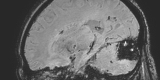 Cavernous hemangioma of the cerebellar falx (Radiopaedia 73025-83724 Sagittal BOLD 72).jpg