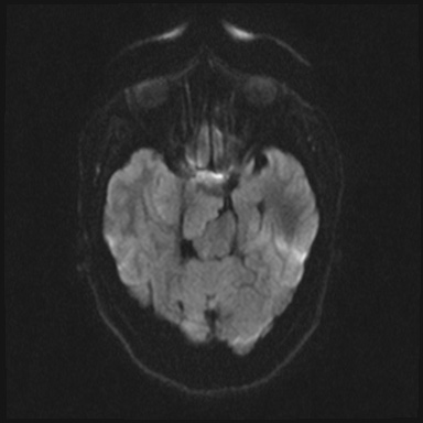 Cavernous sinus meningioma (Radiopaedia 63682-72367 DWI 49).jpg