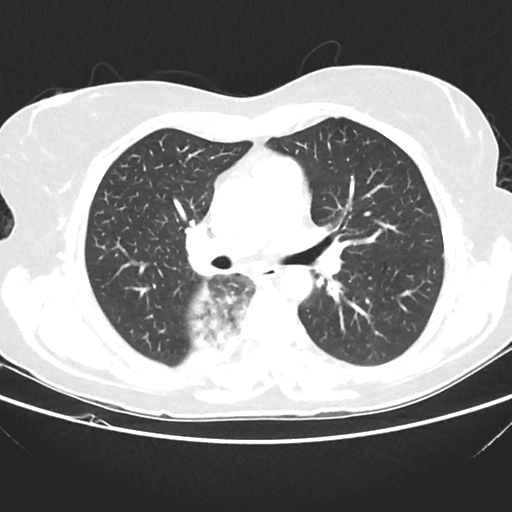File:Cavitating lung mass - squamous cell carcinoma (Radiopaedia 48047-52854 Axial lung window 23).png