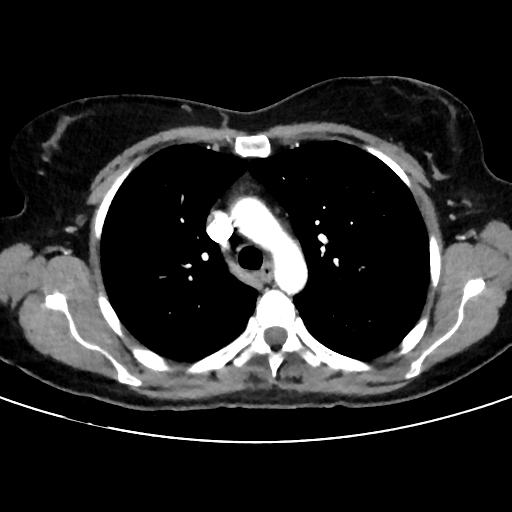 File:Cavitating lung mass - squamous cell carcinoma (Radiopaedia 48047-52854 B 17).png