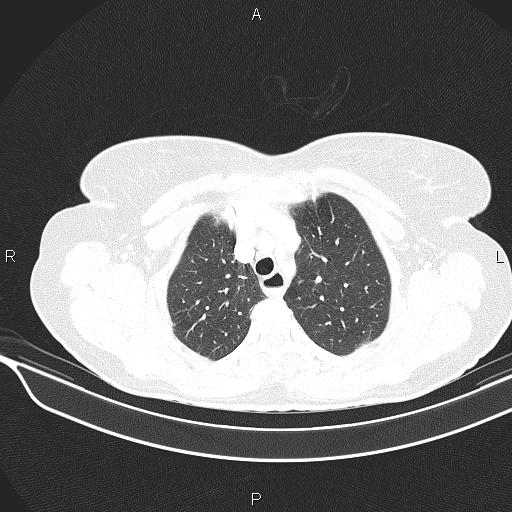 Cecal cancer (Radiopaedia 85610-101358 Axial lung window 15).jpg