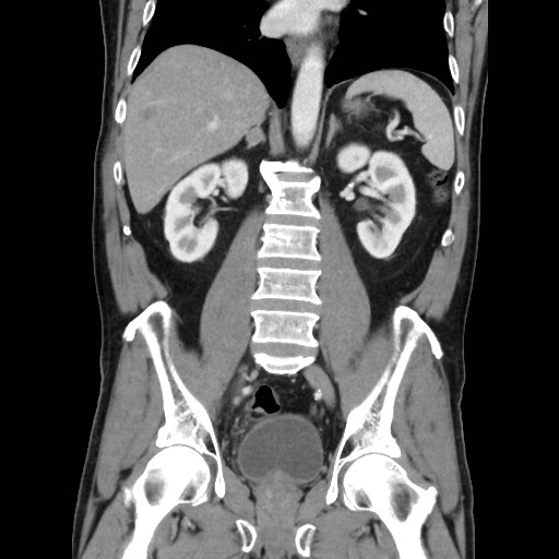 Cecal mass causing appendicitis (Radiopaedia 59207-66531 B 32).jpg