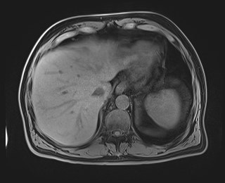 Cecal mass causing appendicitis (Radiopaedia 59207-66532 Axial T1 28).jpg