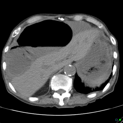 Cecal volvulus - atypical (Radiopaedia 21637-21588 non-contrast 14).jpg