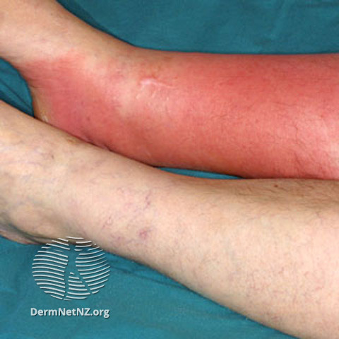 File:Cellulitis affects people of all ages and races. Predispositions to cellulitis include- (DermNet NZ bacterial-s-cellulitis2).jpg