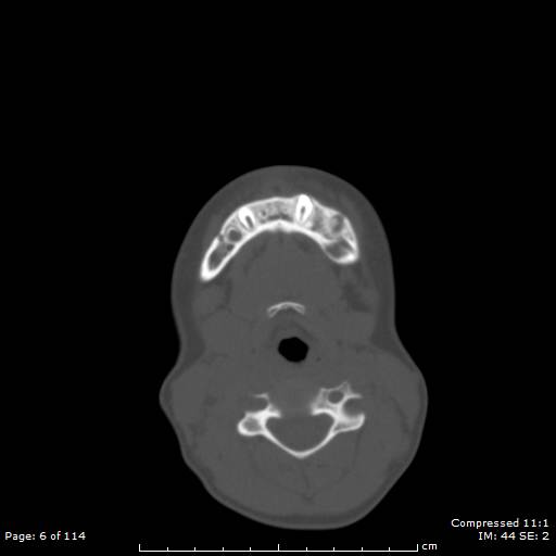 File:Central giant cell granuloma (Radiopaedia 45612-49754 Axial bone window 3).jpg