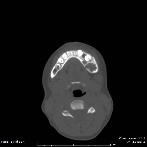 File:Central giant cell granuloma (Radiopaedia 45612-49754 Axial bone window 7).jpg