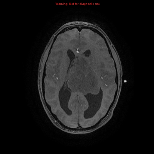 File:Central neurocytoma (Radiopaedia 13188-13206 Axial MRA 28).jpg