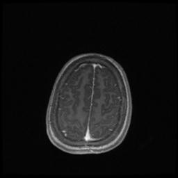 Central neurocytoma (Radiopaedia 30220-30842 Axial T1 C+ 128).jpg