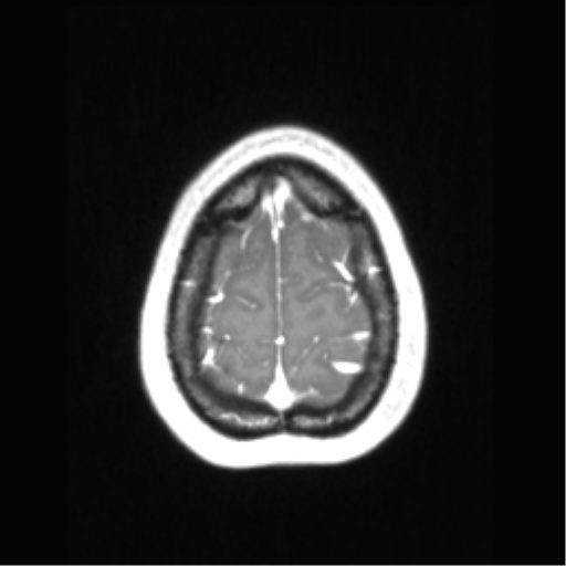 File:Central neurocytoma (Radiopaedia 37664-39557 Axial T1 C+ 71).png