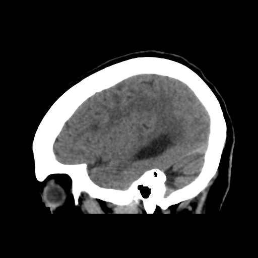 File:Central neurocytoma (Radiopaedia 65317-74346 C 41).png