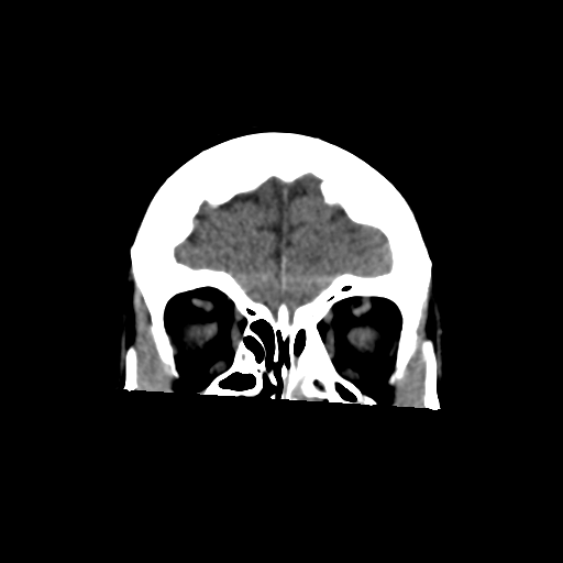 File:Central neurocytoma (Radiopaedia 65317-74346 Coronal non-contrast 12).png
