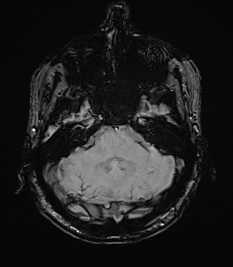 File:Central neurocytoma (Radiopaedia 71068-81303 Axial SWI 11).jpg