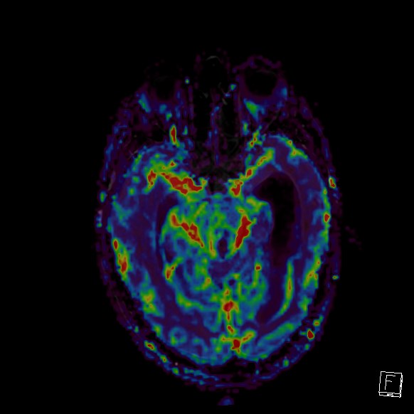 Central neurocytoma (Radiopaedia 84497-99872 Axial Perfusion 202).jpg