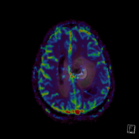 Central neurocytoma (Radiopaedia 84497-99872 Axial Perfusion 94).jpg