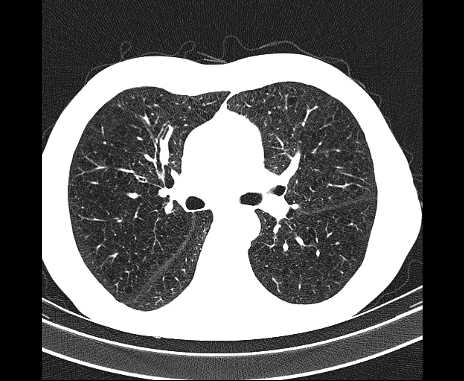 Centrilobular pulmonary emphysema (Radiopaedia 62468-70718 Axial lung window 34).jpg