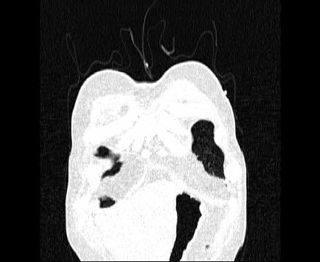 Centrilobular pulmonary emphysema (Radiopaedia 62468-70718 Coronal lung window 7).jpg