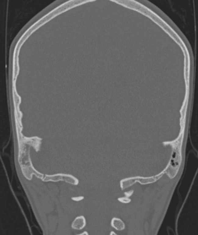 Cerebellar abscess (Radiopaedia 73727-84527 Coronal bone window 29).jpg