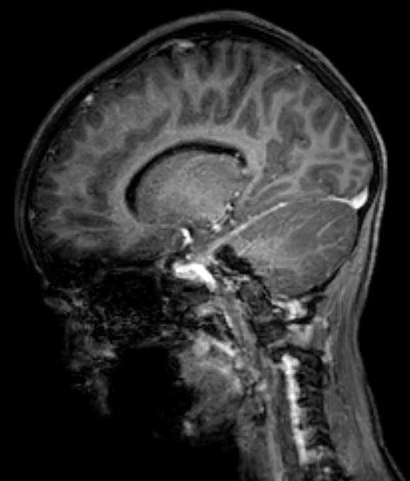 Cerebellar abscess (Radiopaedia 73727-84563 J 40).jpg