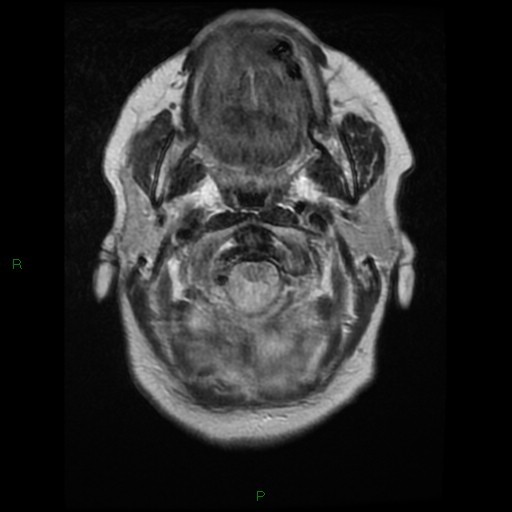 File:Cerebellar abscess (Radiopaedia 78135-90678 Axial T2 2).jpg