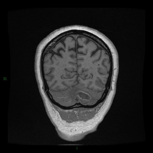Cerebellar abscess (Radiopaedia 78135-90678 Coronal T1 C+ 136).jpg