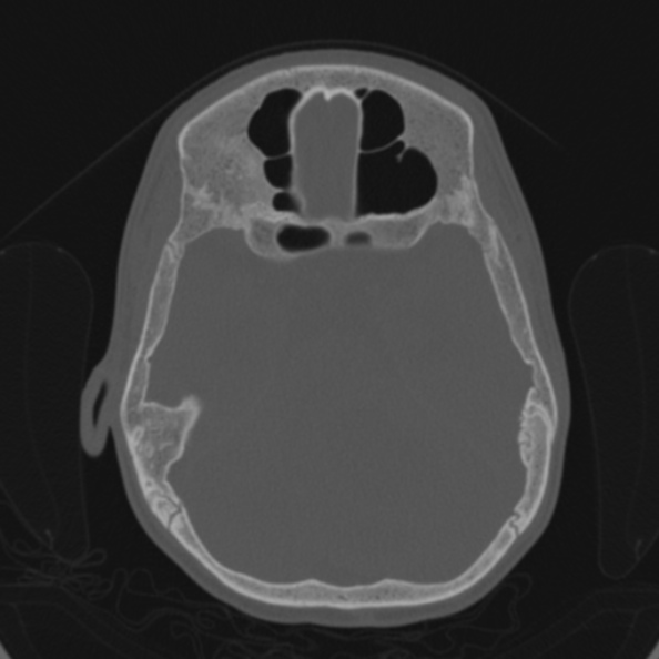 Cerebellar abscess secondary to mastoiditis (Radiopaedia 26284-26413 Axial bone window 79).jpg