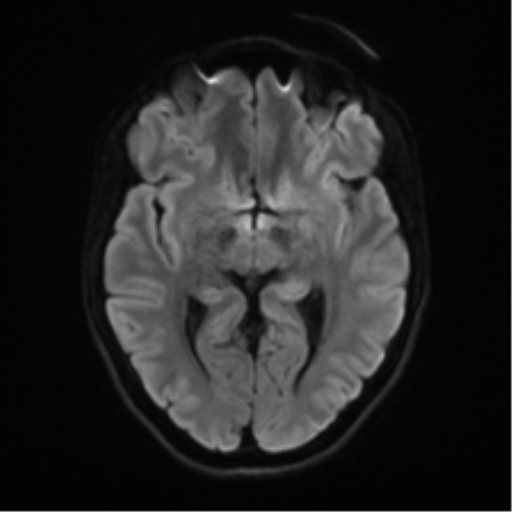 Cerebellar agenesis with hypoplastic pons (pontocerebellar hypoplasia) (Radiopaedia 57224-64138 Axial DWI 54).png