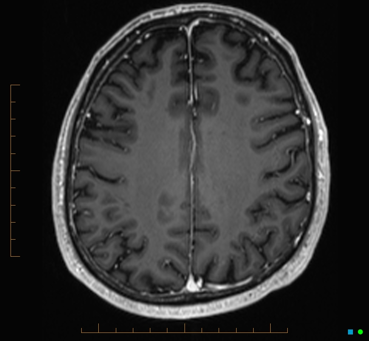 Cerebellar gangliocytoma (Radiopaedia 65377-74422 Axial T1 C+ 96).jpg
