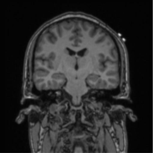 Cerebellar hemangioblastomas and pituitary adenoma (Radiopaedia 85490-101176 Coronal T1 47).png