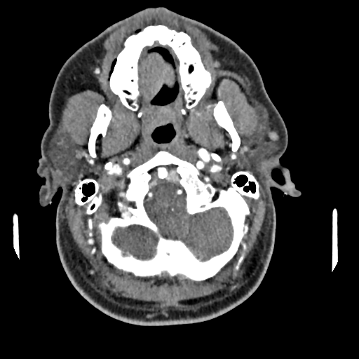 Cerebellar infarct due to vertebral artery dissection with posterior fossa decompression (Radiopaedia 82779-97029 C 48).png