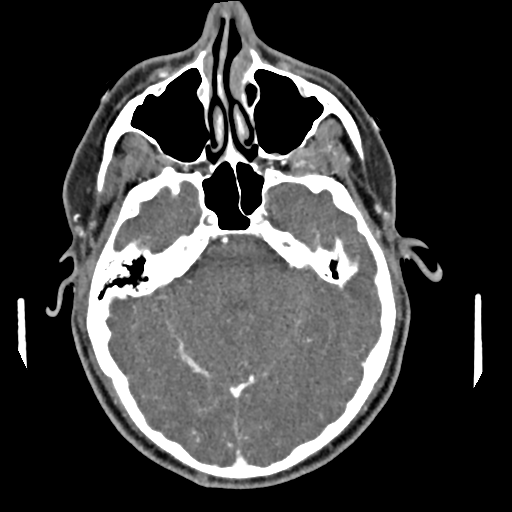 Cerebellar infarct due to vertebral artery dissection with posterior fossa decompression (Radiopaedia 82779-97029 C 6).png
