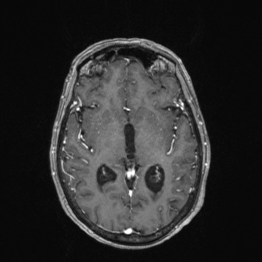 Cerebellar metastases (Radiopaedia 24038-24249 Axial T1 C+ 16).jpg