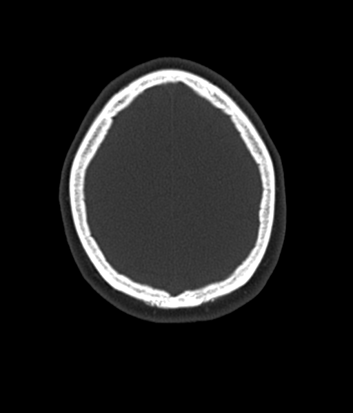 Cerebellar metastases - colorectal adenocarcinoma (Radiopaedia 40947-43652 AX Bone C- 2.0 MPR 54).png