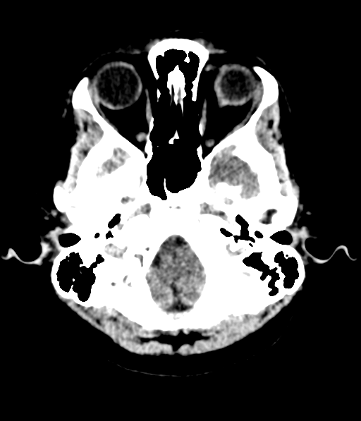 File:Cerebellar metastases - colorectal adenocarcinoma (Radiopaedia 40947-43652 Axial non-contrast 9).png