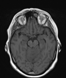 File:Cerebellar metastasis (Radiopaedia 54578-60810 Axial T1 15).png