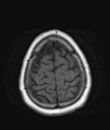 File:Cerebellar metastasis (Radiopaedia 54578-60810 Axial T1 34).png