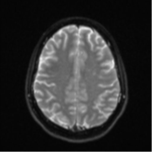 Cerebellar metastasis - adenocarcinoma lung (Radiopaedia 63184-71715 Axial DWI 22).png