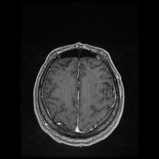 Cerebellar metastasis of pulmonary adenocarcinoma, cavernous venous malformation, and developmental venous anomaly (Radiopaedia 85827-101661 Axial T1 C+ 71).jpg
