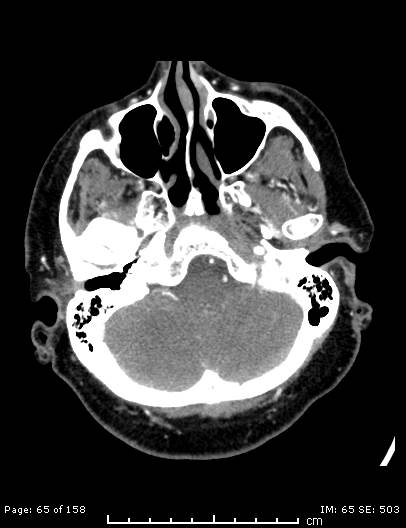 Cerebellar strokes due to intracranial giant cell arteritis (Radiopaedia 68799-78510 CT angiogram 65).jpg