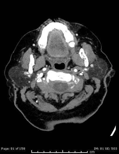 Cerebellar strokes due to intracranial giant cell arteritis (Radiopaedia 68799-78510 CT angiogram 81).jpg