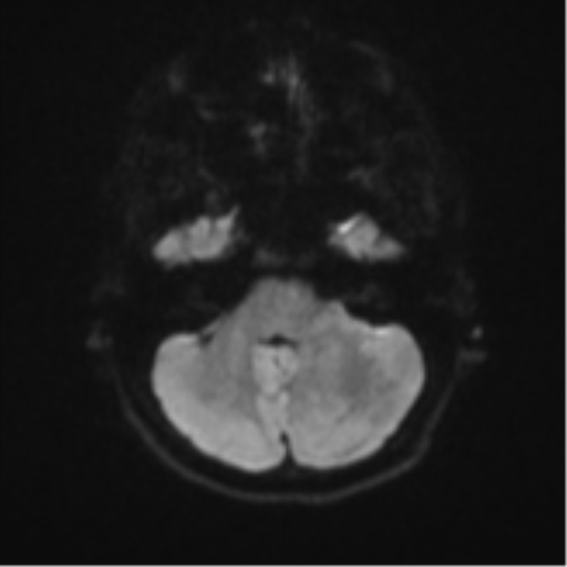 Cerebellar tuberculomas (Radiopaedia 46939-51472 Axial DWI 35).png