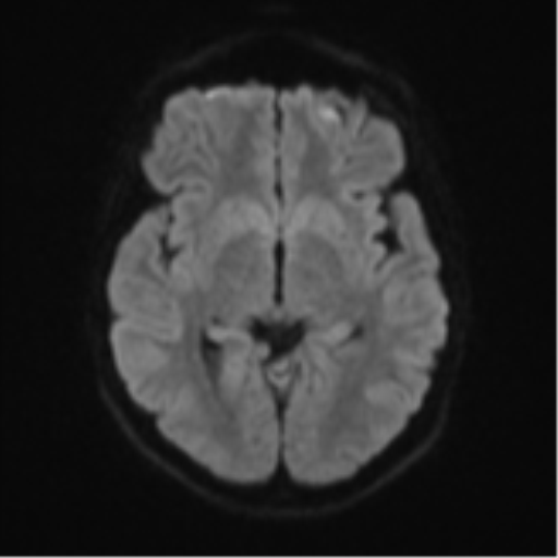 Cerebellar tuberculomas (Radiopaedia 46939-51472 Axial DWI 42).png
