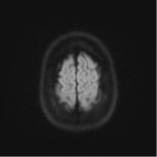 Cerebellar tuberculomas (Radiopaedia 46939-51472 Axial DWI 54).png