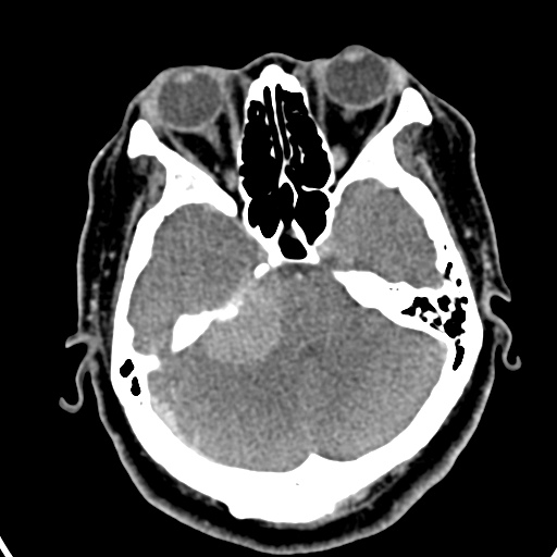 Cerebellopontine angle meningioma (Radiopaedia 35181-36714 A 21).jpg