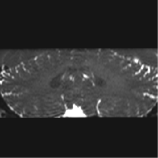 Cerebellopontine angle meningioma (Radiopaedia 48434-53348 Coronal T2 20).png