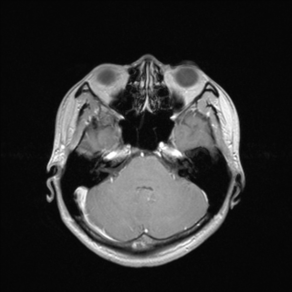 Cerebral abscess (Radiopaedia 24212-24478 Axial T1 C+ 20).jpg